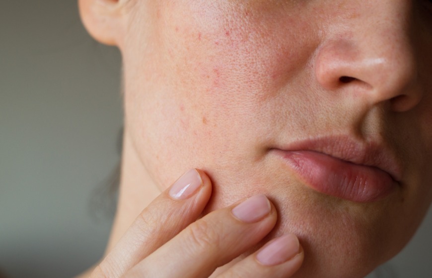 Best treatment for hyperpigmentation in Dubai Best treatment for hyperpigmentation in Dubai